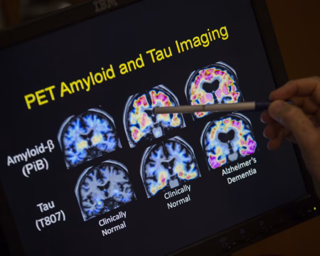 Australia Approves New Drug to Treat Early Alzheimer’s Disease