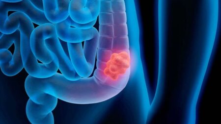 Cancer deaths of Americans under 50 have nearly halved — but not colon cancer